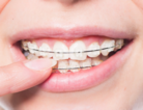 Clear Ceramic Braces